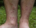 230px-Cercarial_dermatitis_lower_legs